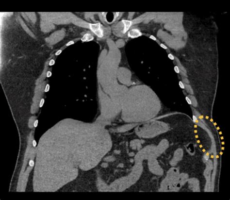 Adult Chest Wall Surgery Program Department Of Cardiothoracic Surgery