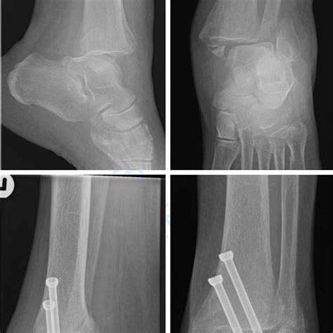 Top Bimalleolar Ankle Fracture With Talar Shift Bottom Radiographs At