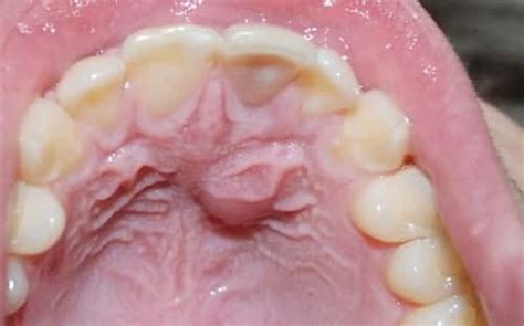 Roof Of Mouth Hurts Causes And Treatment