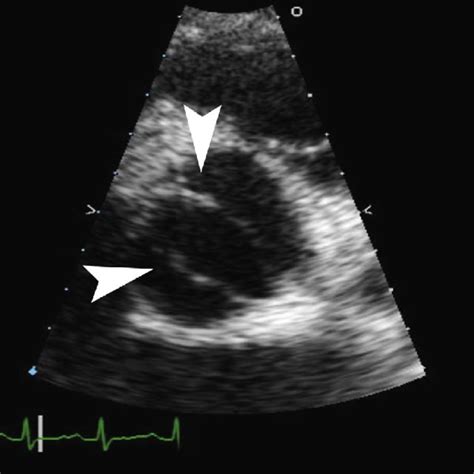 Dysplastic Mitral Valves White Arrow Can Be Seen Below The