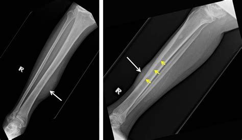 Primary Lymphoma Of The Soft Tissue Leg Radiology Cases