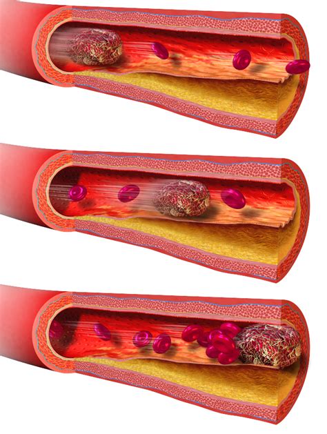 Difference Between Thrombus And Embolus Compare The Difference