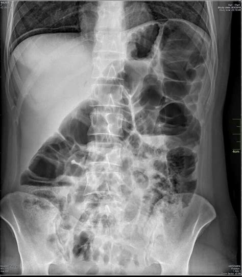 an x ray image shows the chest and ribs which are visible in black and white