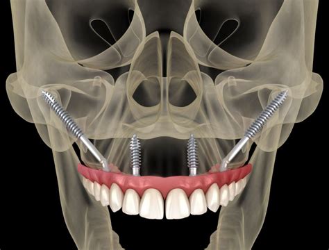 Zygomatic Dental Implants Fort Worth Arlington And Weatherford Tx