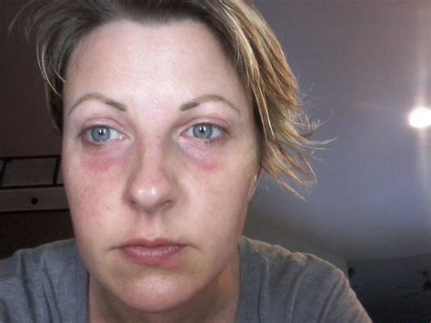 My Itchy Journey Overcoming 10 Years Of Misdiagnosed Skin Allergies