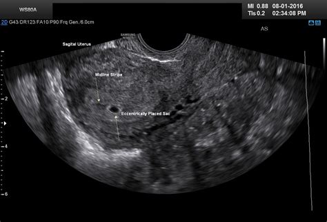 How Early Can The Gestational Sac Be Seen On Ultrasound Wallpaper