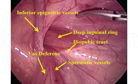 Figure 2 From Chapter 5 Inguinal Hernia In Infancy And Children