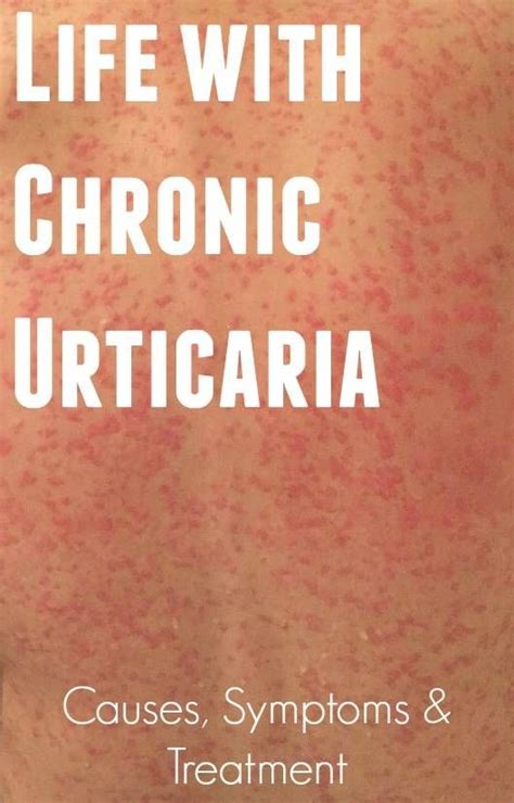 17 Best Images About Pruritus And Urticaria On Pinterest Health
