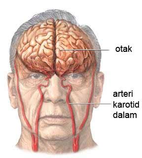 Terapi Stroke I Obat Stroke I Dapat Ditangani Dengan Tuntas Stroke