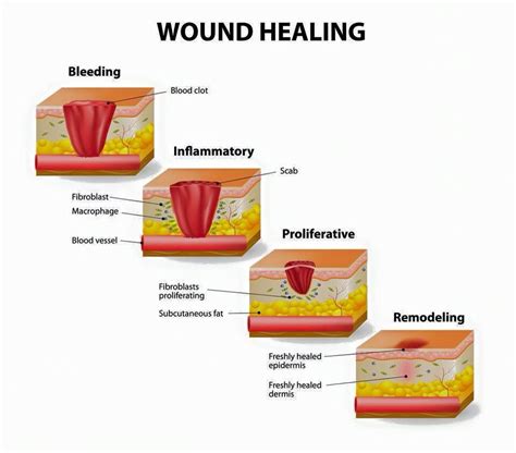 Wound Healing Wound Care Wound Care Nursing Wound Healing