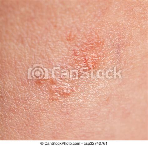 Skin Fungus On His Red Spots On The Backs Of Stock Photo By