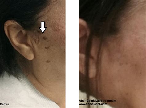 Seborrheic Keratosis Removal In New Jersey Soma Skin Laser