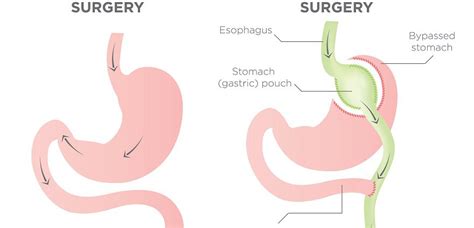 Where you live can affect how much your surgery costs, especially. Gastric Bypass Surgery | Can It Work For You? What Does it ...