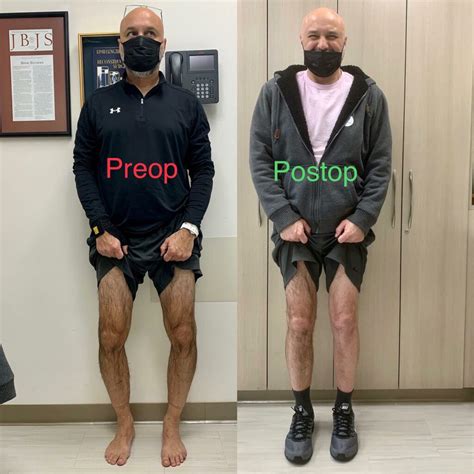 Bowleg Deformity Before And After Photos Limb Lengthening