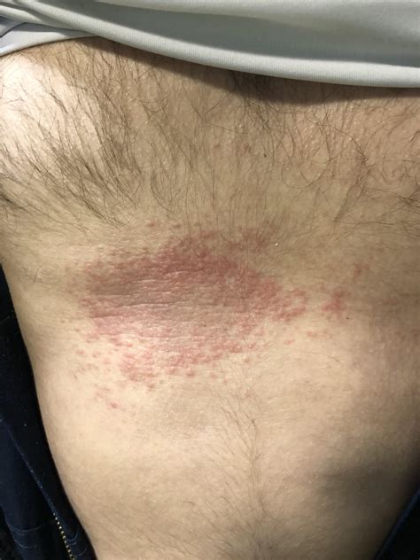 Need Help Identifying This Rash 3 Days Since Start It Has Tripled In