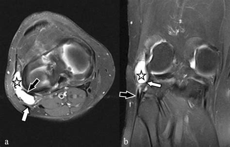 Mri Characteristics Of Cysts And “cyst Like” Lesions In And Around The