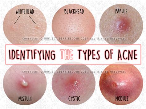Understanding The Types Of Acne — Whitehead Blackhead Papule Pustule