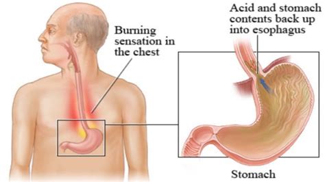 A burning throat is a common symptom of infections and other underlying medical conditions. Acid Reflux Symptoms: Signs and Symptoms of Acid Reflux ...