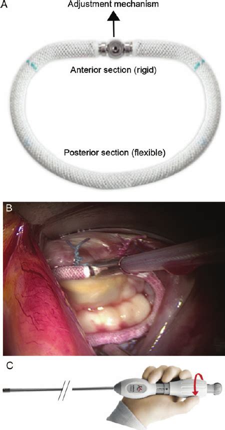 The Cardinal Adjustable Annuloplasty Ring System A The Cardinal