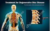 Therapy For Degenerative Disc Disease Photos