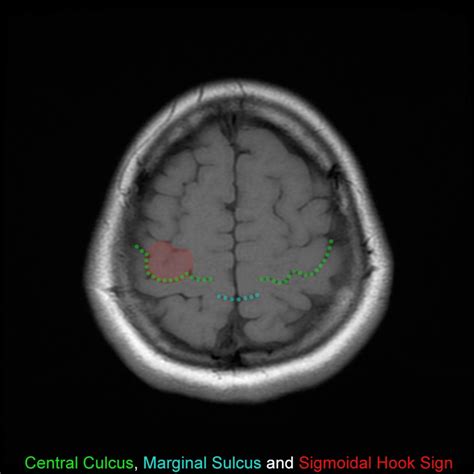 Central Sulcus Marginal Sulcus And Sigmoidal Hook Sign Download