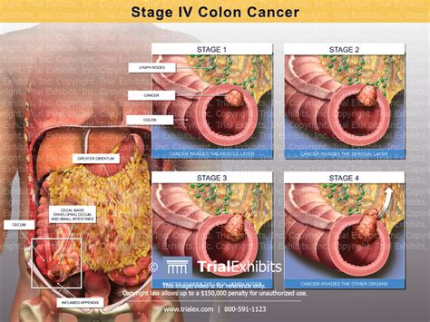 What Is Stage Iv Colon Cancer Cancerwalls