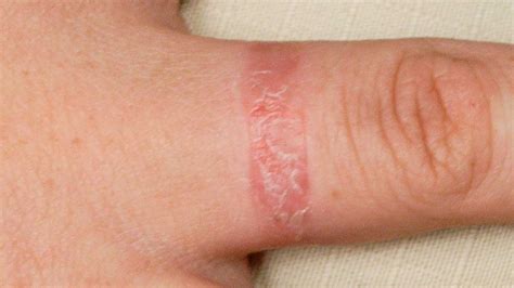 Allergic Contact Dermatitis Hand Dermatitis The Dermatologist My Xxx