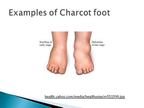 Mar 23, 2020 · charcot arthropathy can occur at any joint; Charcot foot physical therapy