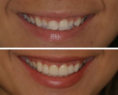 Veneers Before And After Pictures Before And After