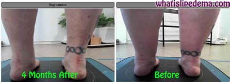 If you're on the lookout for foods that can help lower your risk. Calf Liposuction for Lipedema - What is Lipedema?