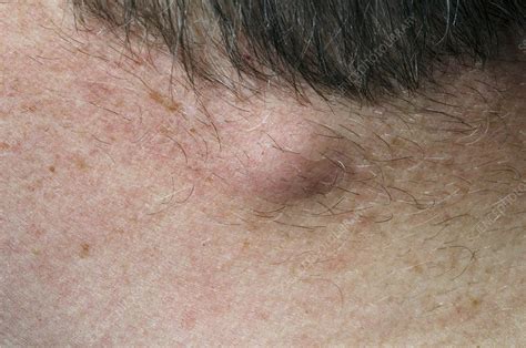 Sebaceous Cyst On The Neck Stock Image C0169240 Science Photo