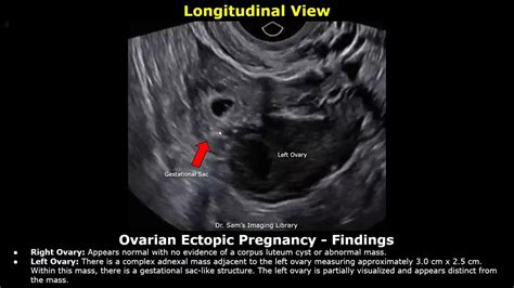 Ectopic Pregnancy Ultrasound Reporting Tubal Interstitial Cervical
