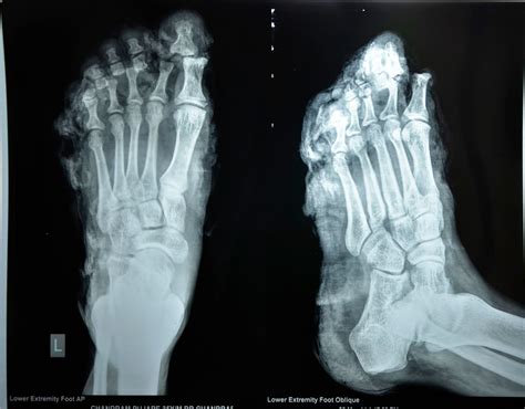 Crush Injury Foot Lower Limb Injuries And Limb Salvage Major Crush