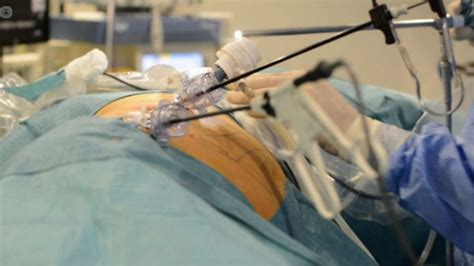 Cirugía de hernia inguinal en Toluca Cirujano con 8 000 Procedimientos