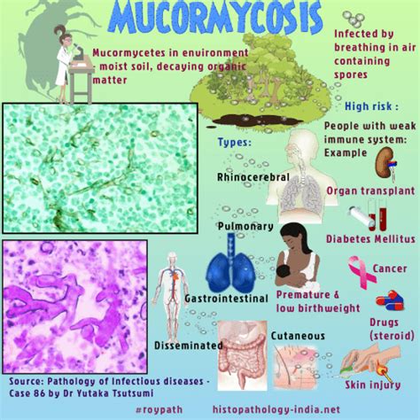 Mucormycosis (previously called zygomycosis) is a serious but rare fungal infection caused by a group of molds called mucormycetes. Pathology of Mucormycosis (Zygomycosis) - Dr Sampurna Roy MD