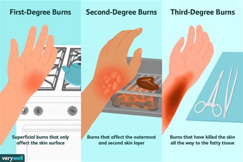 First Aid For Burns 1st 2nd And 3rd Degree 2023