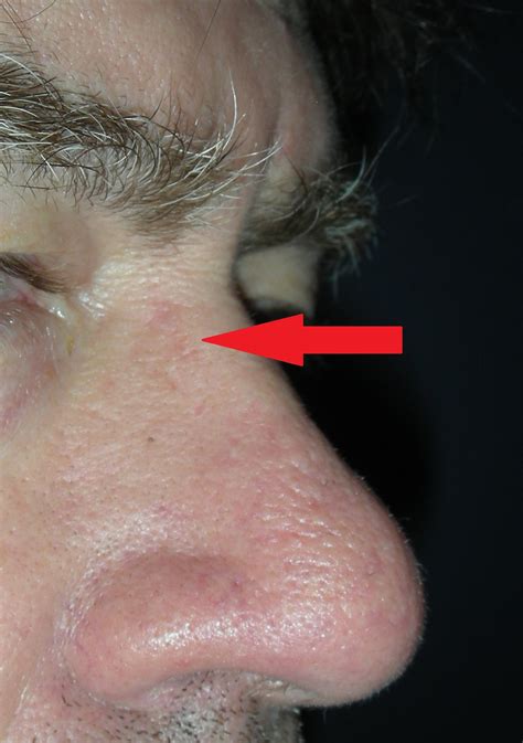 Skin Cancer Nose With Local Flap Repair Dr Damian Marucci Cosmetic