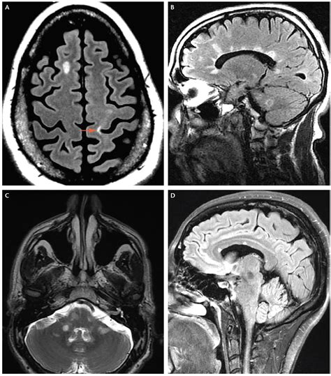 Current treatment options in neurology, 21(12). Multiple Sclerosis Misdiagnosis - Practical Neurology