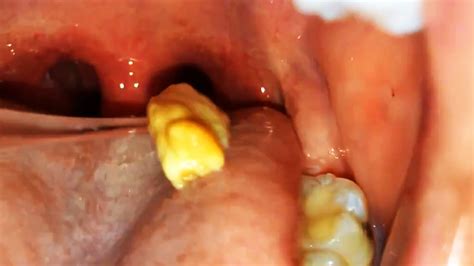Biggest Tonsil Stones Ever Tonsil Stones Removal Tips