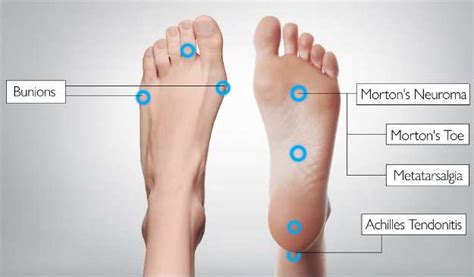 Foot Pain Identifier Chart