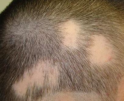 Alopecia Da Stress Cause Sintomi E Cura Vivere Al Meglio