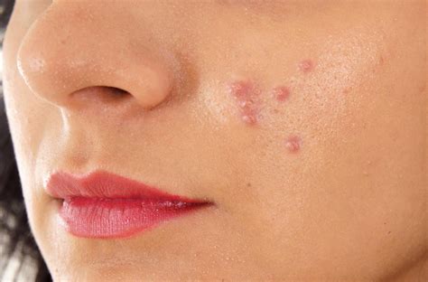 Hard Pimples Treatment Prevention And Causes