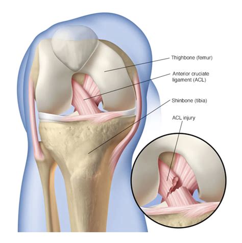 ACL Reconstruction Arthromed Arthroscopy Joint Replacement Centre Jabalpur