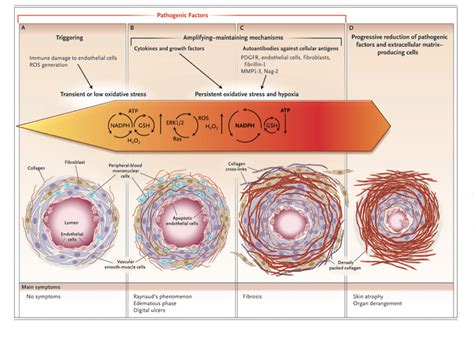 Systemic Sclerosis: Advances and Prospects – Global Health News Wire