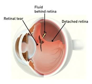 The retina is an extremely fragile tissue that lines the eye's back wall, consisting mostly of nerves. Detached and Torn Retina - Riverside Eye Center