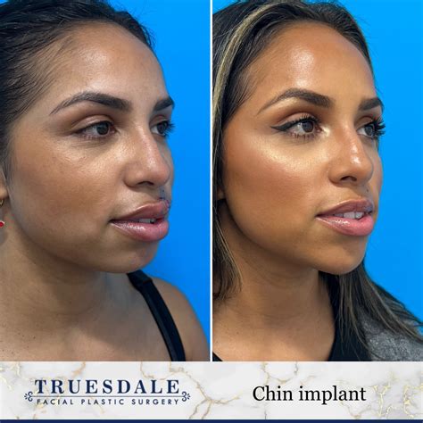 Chin Augmentation Beverly Hills Truesdale Facial Plastic Surgery
