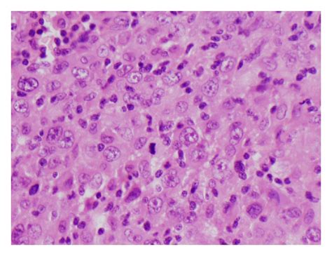 Pleomorphic Epitheloid Cells Having Vesicular Nuclei And Prominent