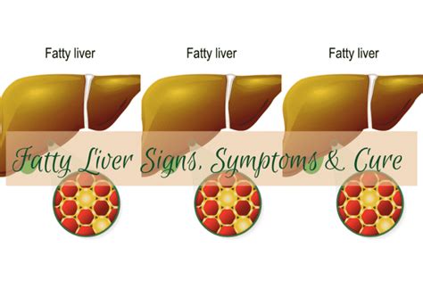 Fatty Liver Signs Symptoms And The Cure You Need To Know About Before It