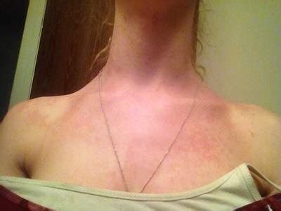 Neck And Chest Rash Pictures Photos