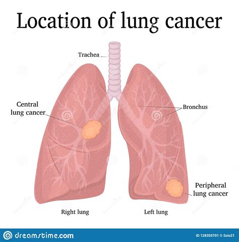 Location Of Lung Cancer Stock Vector Illustration Of Development